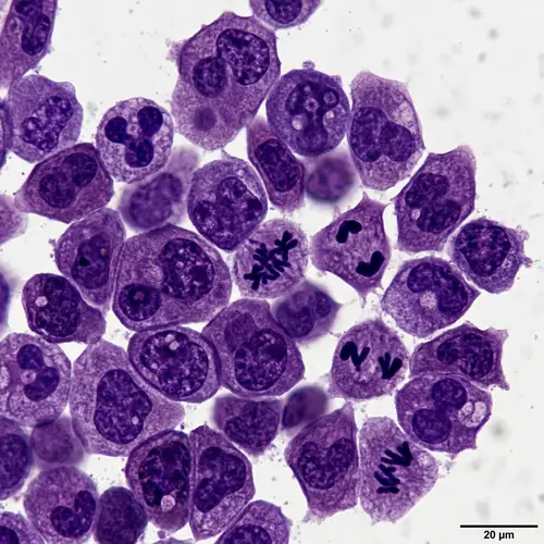 Irregular Cancer Cells Under Microscope
