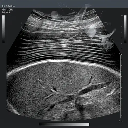 Abstract Diaphragmatic Ultrasound Imaging