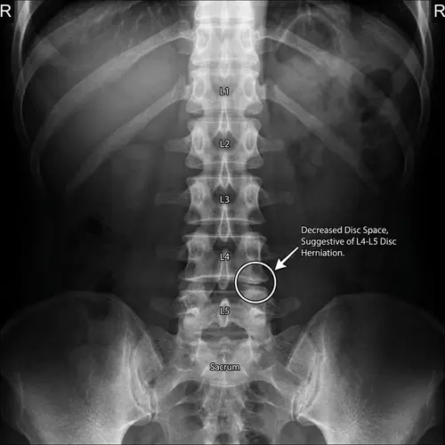 Herniated Disc Condition X-ray Image