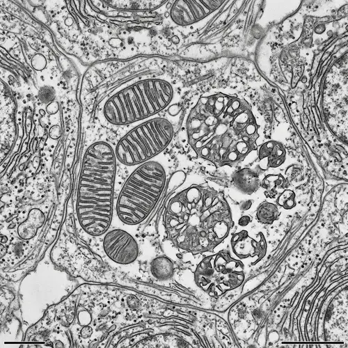 Dysfunctional Mitochondria: Microscopic Abnormality