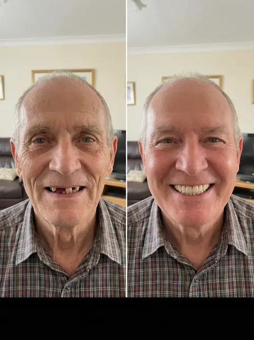 What Would I Look Like with Dentures?