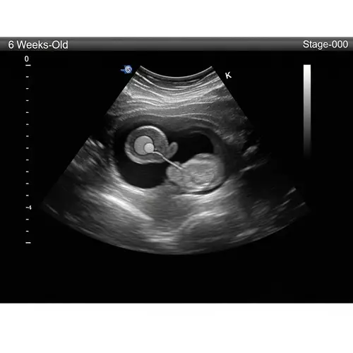 6 Weeks Old Ultrasound: Embryonic Development in Uterus