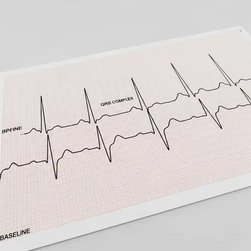 Illustration of Medical Electrocardiogram with Atrial Fibrillation