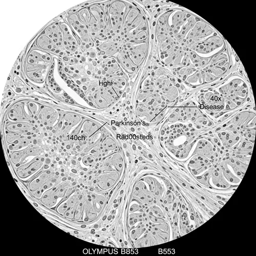 Parkinson's Disease Brain Tissue Microscopic Examination