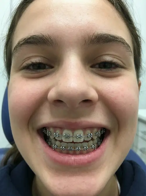 How Would I Look with Braces? Find Out Now!