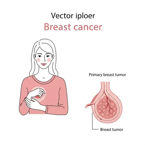 Breast Cancer Patient & Tumor Vector Diagram - Academic Illustration