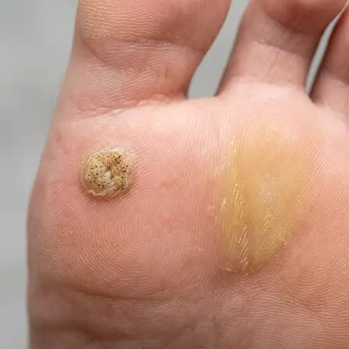 Wart and Callus Close-Up: Treatment and Prevention Tips