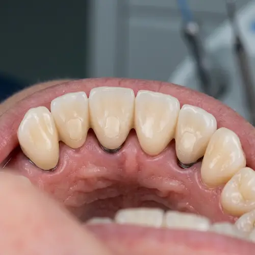4-Element Implant Prosthesis with 3 Implants
