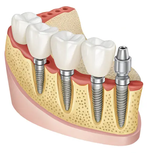 4-Element Implant Prosthesis with 3 Implants