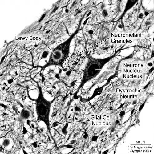 Parkinson's Disease Brain Tissue Microscopic Examination