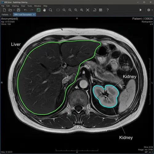 AI-Powered MRI Liver and Kidney Segmentation