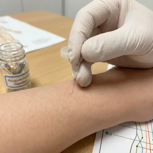 Intricate Meridian-Style Japanese Acupuncture Close-Up Image