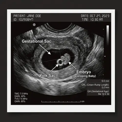 6 Weeks Old Ultrasound: Embryonic Development in Uterus