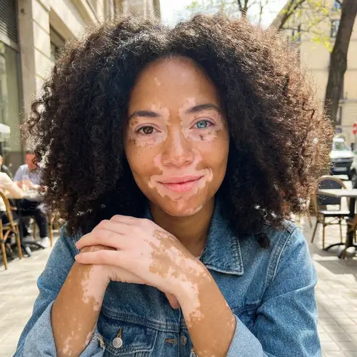 Stunning Woman with Vitiligo and Heterochromia