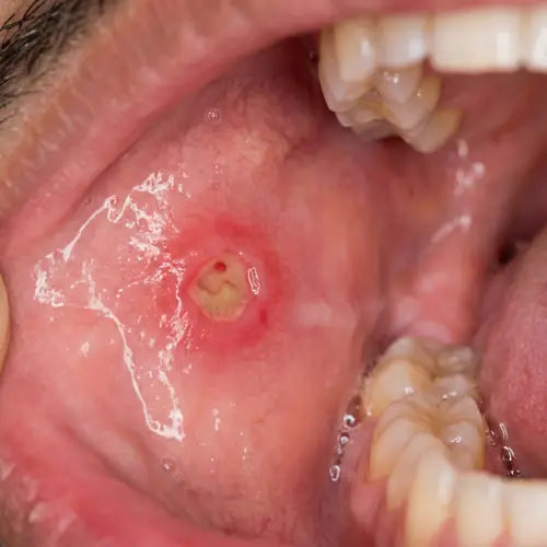 Realistic Mouth Sore Depiction - Middle-Eastern Man