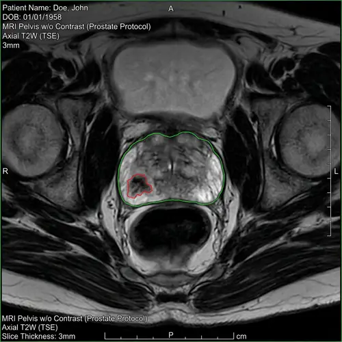 Prostate Gland MRI Scan with Lesion - T2-Weighted Imaging
