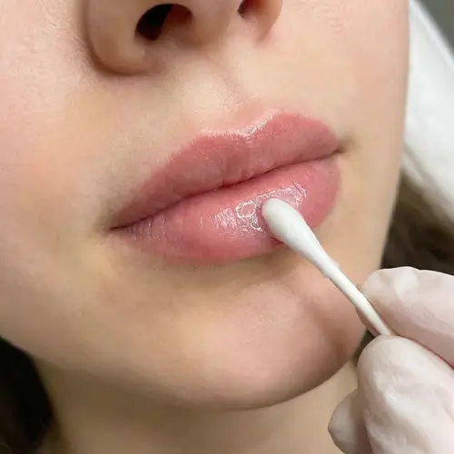 Candy Lips Procedure for Natural Pink Pigmentation | Expert Services