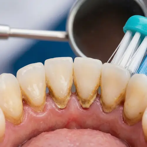 Tartar Buildup on Teeth: Causes & Prevention