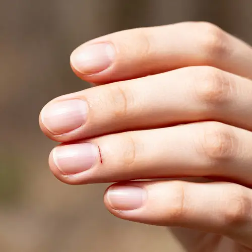 Minor Cut on Finger - Close-Up Hand Image