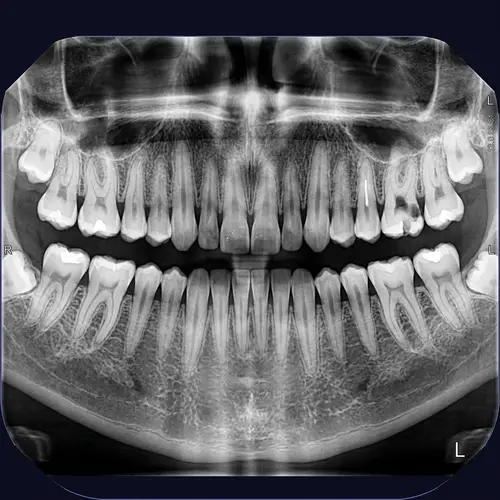 Detailed Oral Dental X-Ray Imaging
