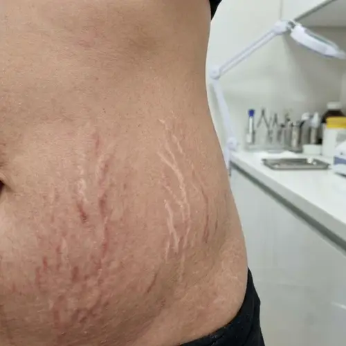 Plasmapen Fibroblast Treatment Before and After