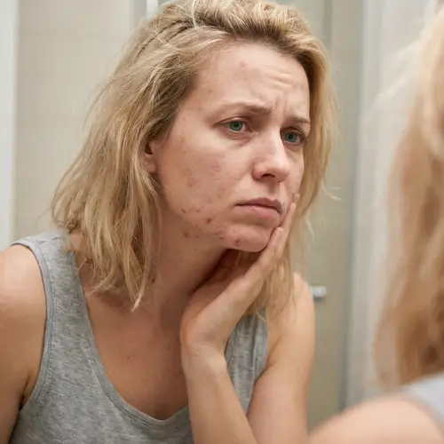 Struggles with Acne: A Realistic Portrait