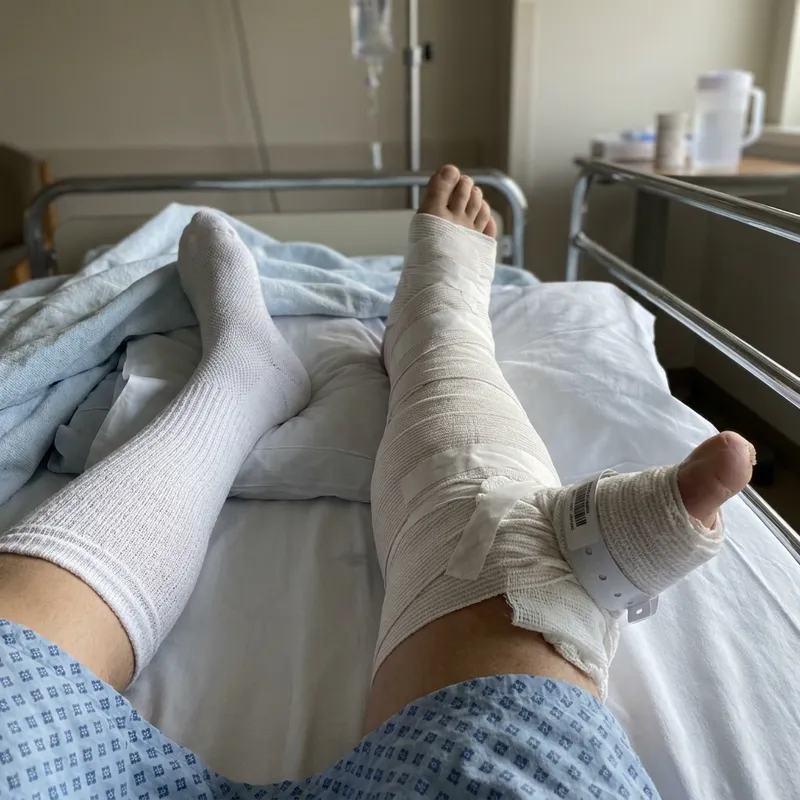 Fractured Leg in Hospital with Bandages Fractured Leg in Hospital with Bandages