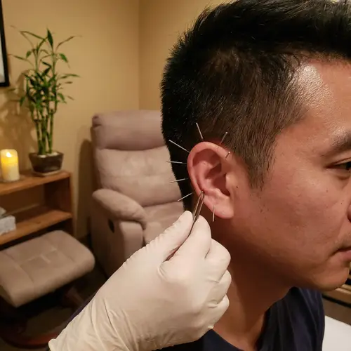 Ear Acupuncture for Calm & Relaxation - Acupuncture Therapy